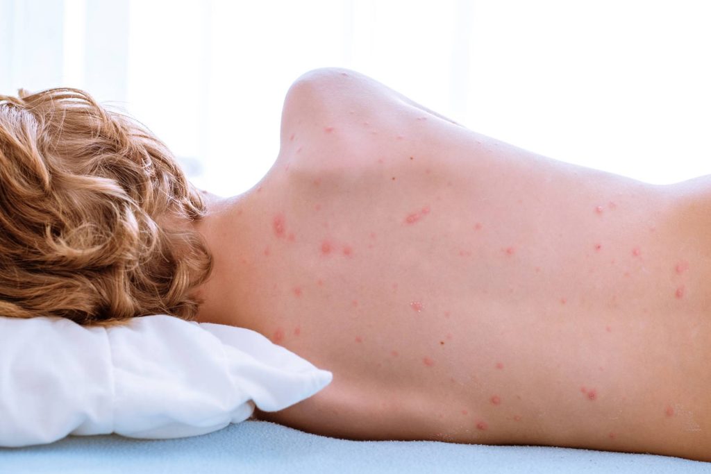 bed bug bites pest control dr pest california